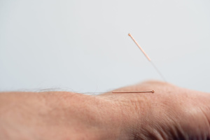 Unfallchirurg-Orthopaede-Hechingen-Gfroerer-Akupunktur-SA900759
